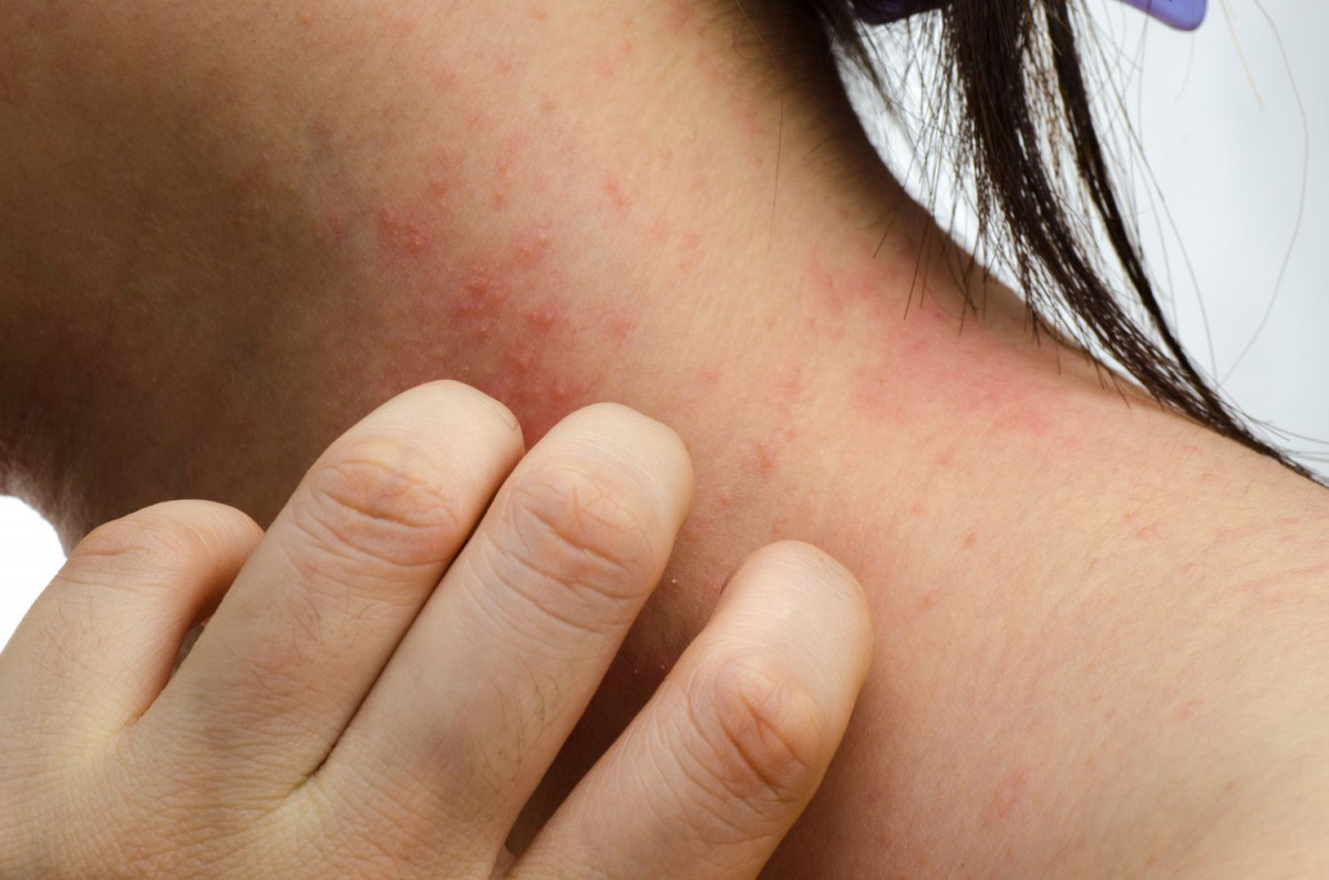 Dermatitis Kontak Iritan